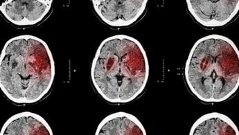 brain scans - stroke